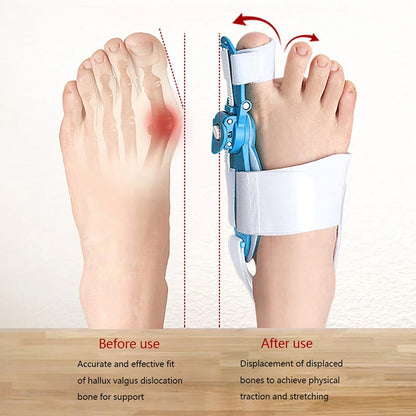 Adjustable Bunion Support Splint – Hallux Valgus Corrector for Men & Women (X7018)